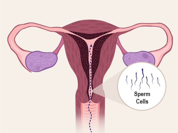 During sex, sperm cells travel through the vagina to the uterus and fallopian tubes.

In the fallopian tube, the sperm meets the egg that was released from the ovary during ovulation.