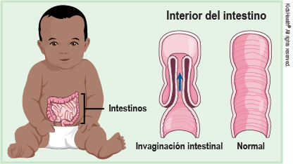 intussusception_a_enIL