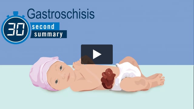 30-Second Summary: Gastroschisis