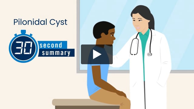 30-Second Summary: Pilonidal Cyst