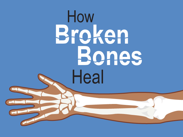 How Broken Bones Heal