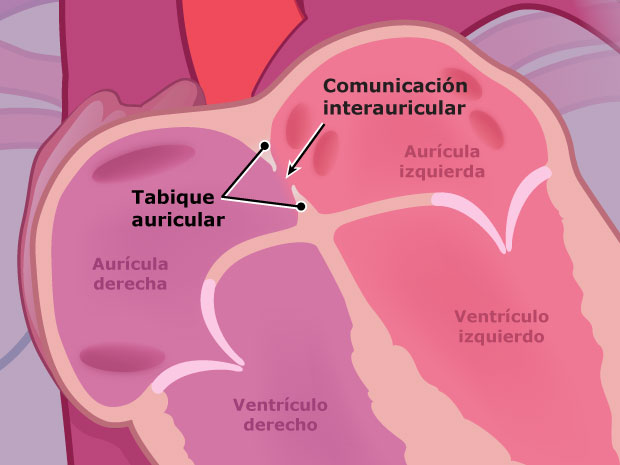 Cuando una persona tiene una comunicación interauricular, hay una abertura en el tabique entre las aurículas derecha e izquierda. Esta parte del tabique se llama "tabique auricular".