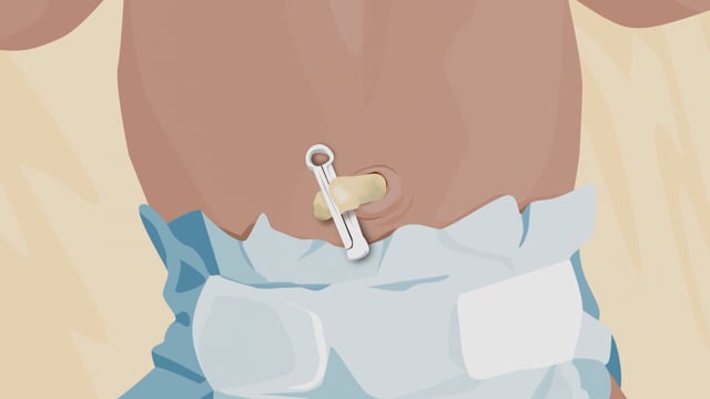 Cómo cuidar el cordón umbilical de su bebé recién nacido