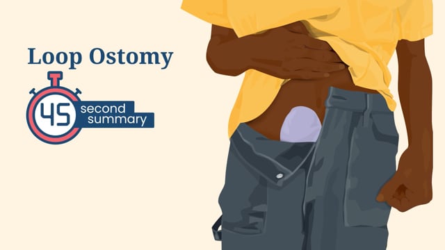 45 Second Summary: Loop Ostomy