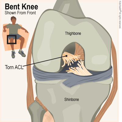 Anterior Cruciate Ligament (ACL) Tears (for Teens)