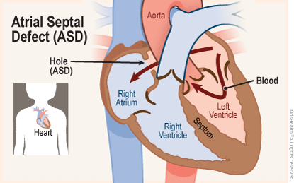Atrial Septal Defect (ASD) (for Parents)