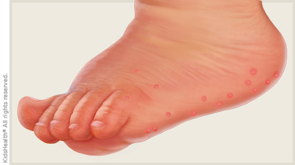 Hand, Foot, and Mouth Disease (for Parents) - Nemours KidsHealth