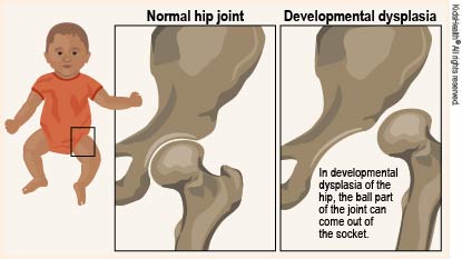 Developmental Dysplasia of the Hip (for 