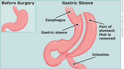 How to Prevent Stomach Stretching After Gastric Sleeve Surgery - Freedom  Bariatrics