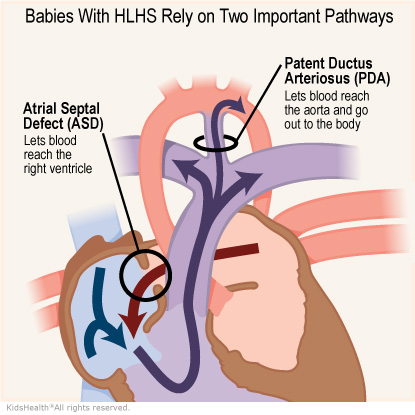 Illustration: Babies with HLHS rely on two important pathways, an ASD and a PDA