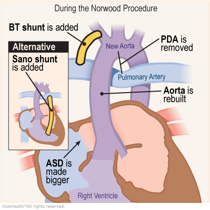 Illustration showing what happens during the Norwood Procedure