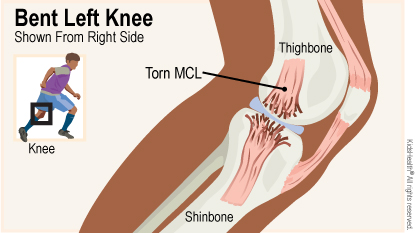 MCL Tear Causes & Treatment  Florida Orthopaedic Institute