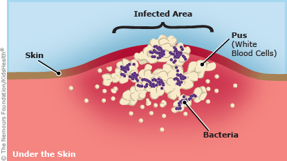 minor staphylococcus infection