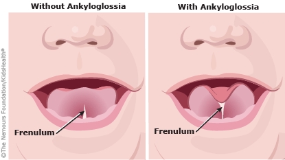 Tongue Tie (Ankyloglossia) (for Parents)