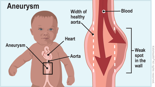 Aortic Aneurysm (for Parents) - Nemours KidsHealth