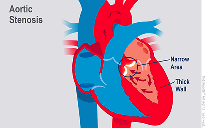 Aortic Stenosis (for Parents) - Nemours Kidshealth