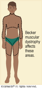 Becker Muscular Dystrophy (for Parents) - Nemours KidsHealth