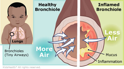 Bronchiolitis (for Parents) - Nemours KidsHealth