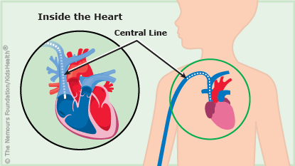 Central Lines (Central Venous Catheters) (for Parents) - Nemours KidsHealth