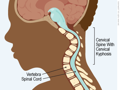 kyphotic cervical spine