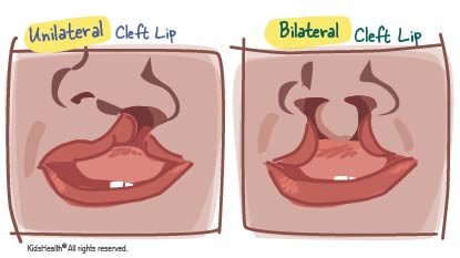 complete cleft lip