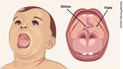 what causes a cleft lip during pregnancy