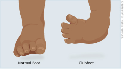Clubfoot For Parents Nemours Kidshealth