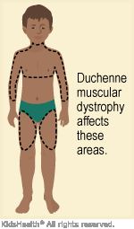 Duchenne Muscular Dystrophy (for Parents) - Nemours KidsHealth