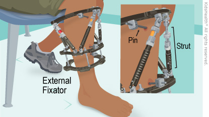 Strapping  definition of strapping by Medical dictionary