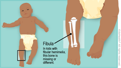 Fibular Hemimelia (for Parents) - Nemours KidsHealth