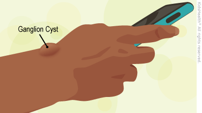 Cure for ganglion cyst