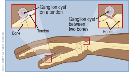 Home remedies for ganglion cyst on wrist