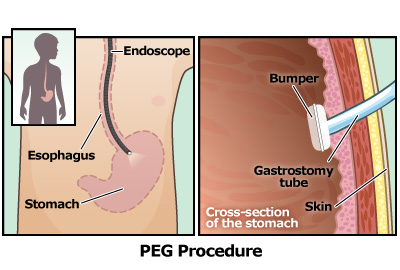 Gastrostomy Tube (G-Tube) (for Parents) - Nemours KidsHealth