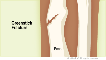 greenstick fracture fibula