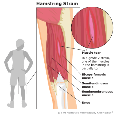 Hamstring Strain: Symptoms, Treatment, and Exercises