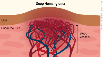 are liver hemangiomas dangerous