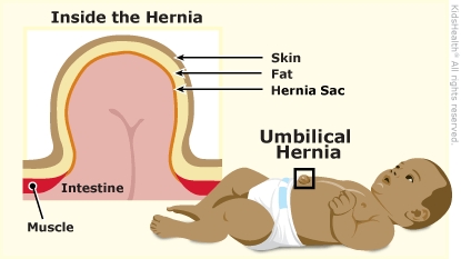 Umbilical Hernia Causes, Symptoms and Treatment