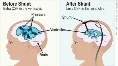 Shunt Placement for Hydrocephalus or Water on the Brain