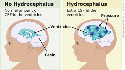 hydrocephalus veins scalp