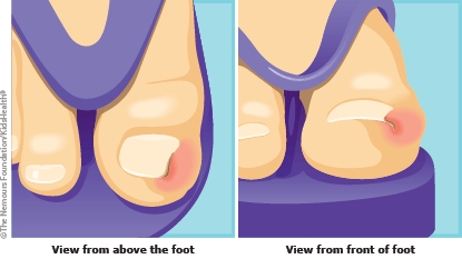 Surgery for ingrowing toenail (child)
