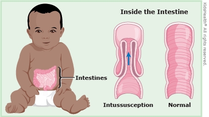Intussusception (for Parents)