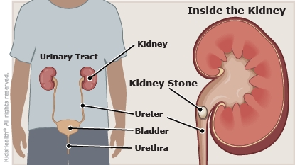 kidney infection pain location