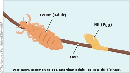 Head Lice (for Parents) - Nemours KidsHealth