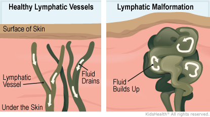 Lymphatic Malformations (for Parents) - Nemours KidsHealth