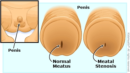 Meatal Stenosis (for Parents) - Nemours KidsHealth