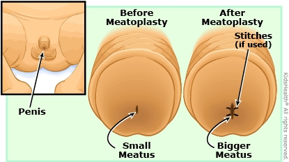 Meatoplasty (for Parents) - Nemours KidsHealth