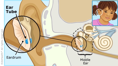 Ear Tube Surgery (for Parents) - KidsHealth