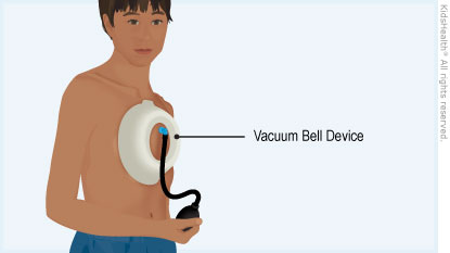 Pectus Excavatum: Vacuum Bell Device (for Parents) - Nemours KidsHealth