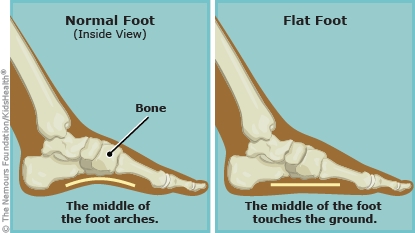 Five Steps for Alleviating Flat Feet Pain