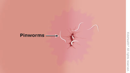 pin worms in humans